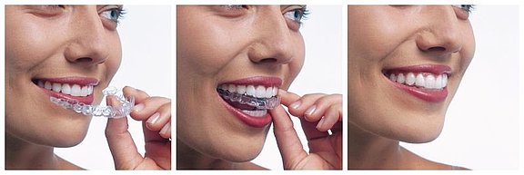 invisalign-reihe.jpg 